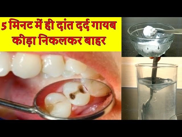 दात दर्द हो रहा है क्या करे यह उपाय जो फायदा है तो कोई बात नहीं है 