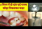 दात दर्द हो रहा है क्या करे यह उपाय जो फायदा है तो कोई बात नहीं है 